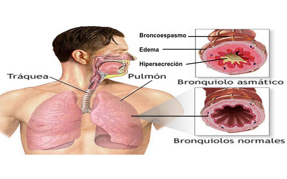 Asma Bronquial Es Una Enfermedad De Los Pulmones Dra Abigail