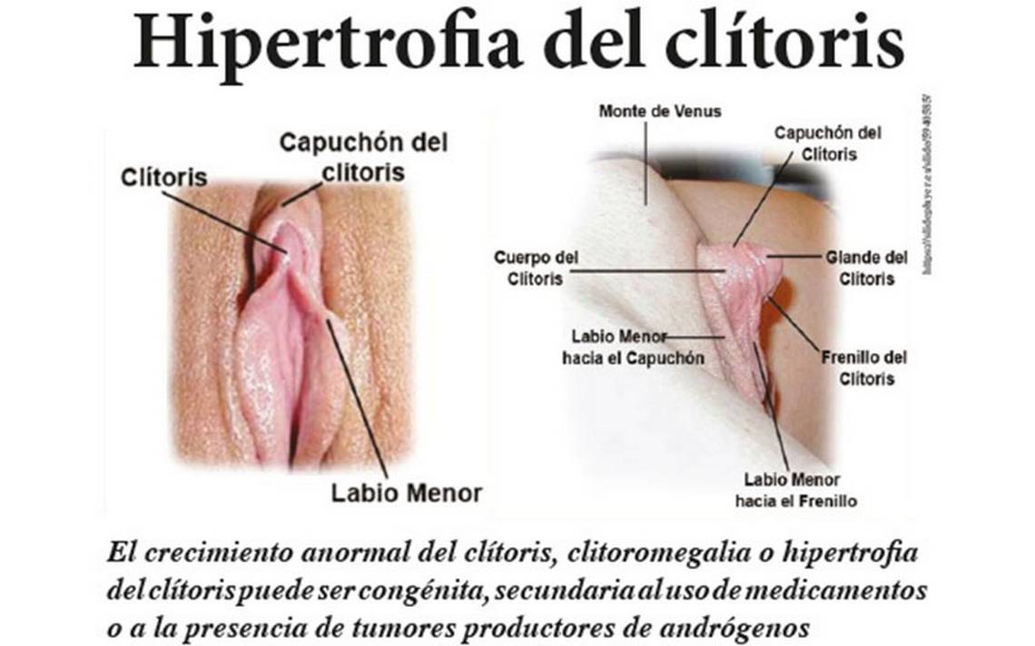 El clítoris y sus enfermedades (Parte 2) - Diario de Xalapa 