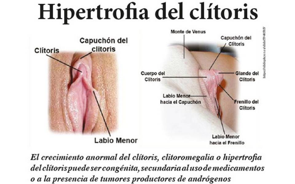 Clitoris anormal