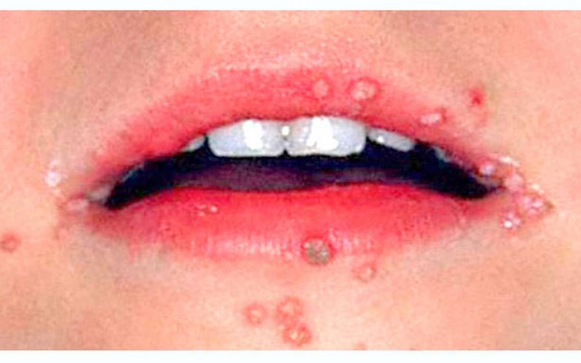 hpv virus lip